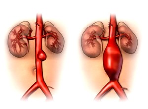 Lee más sobre el artículo Aneurisma de aorta