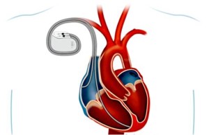 Lee más sobre el artículo Resincronización una luz ante la insuficiencia cardíaca