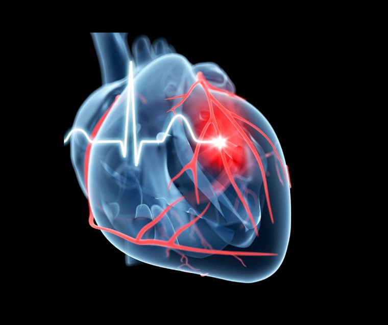 En este momento estás viendo Miocarditis: una afección con síntomas similares a los de un ataque cardiaco